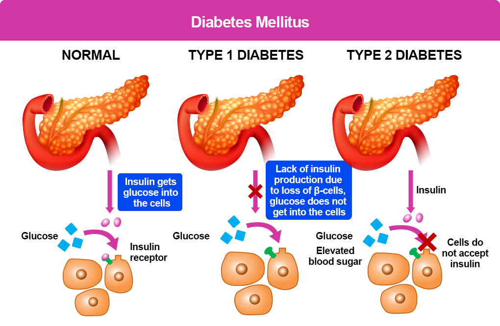 What is Type 1 Diabetes? – T1D