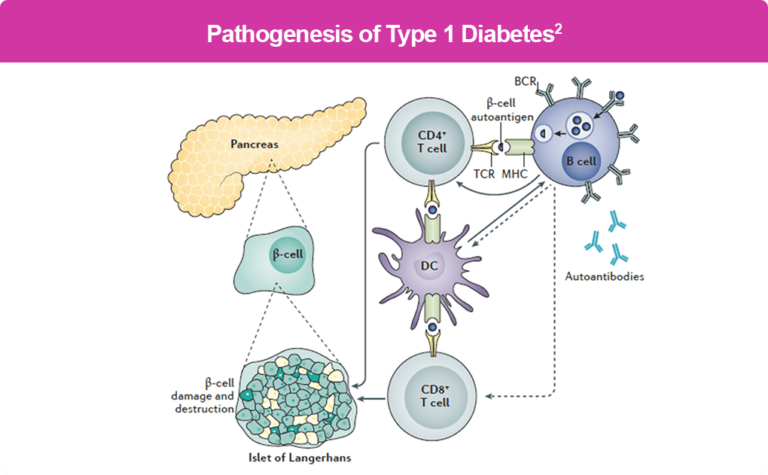 Etiopathogenesis of Type 1 Diabetes – T1D